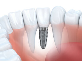 graphic illustration of Gambrills, MD dental implant